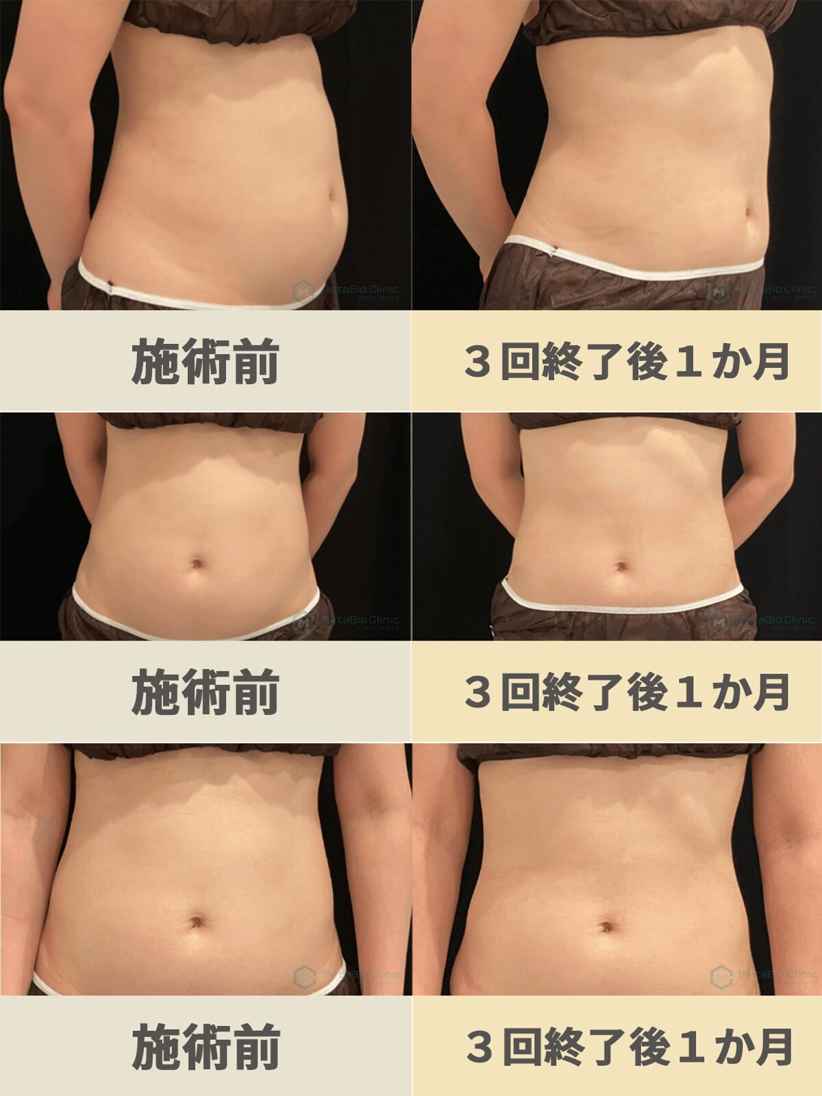 オンダプロお腹の施術前／３回終了後１か月 40代女性